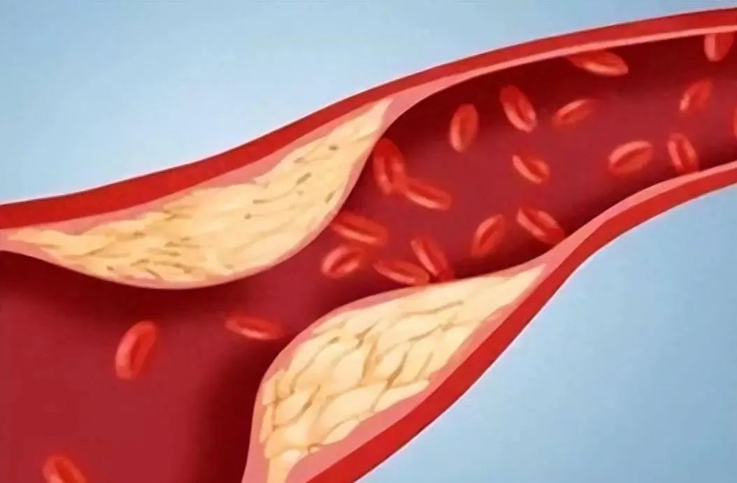 Traditional Chinese Medicine: Enlarged Tongue, Purple-Dark Tongue Body with Teeth Marks? It's Not Just Spleen Deficiency!
