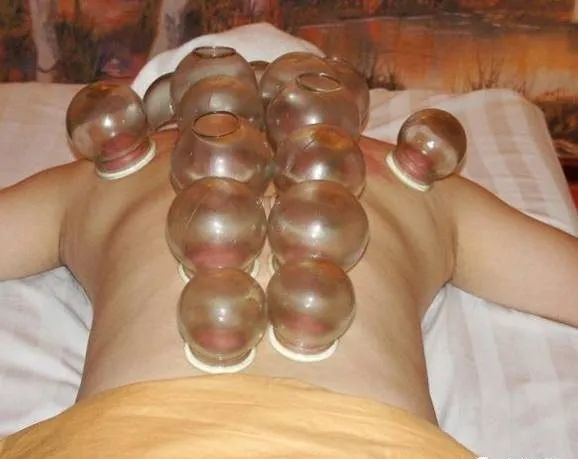 Cupping Therapy in Traditional Chinese Medicine: Meaning, Functions, Contraindications, and Precautions