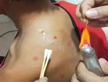 Acupuncture Department II: What Conditions Can Fire Needle Therapy Treat?