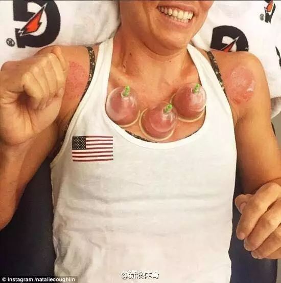 Cupping Therapy Shines at the Rio Olympics