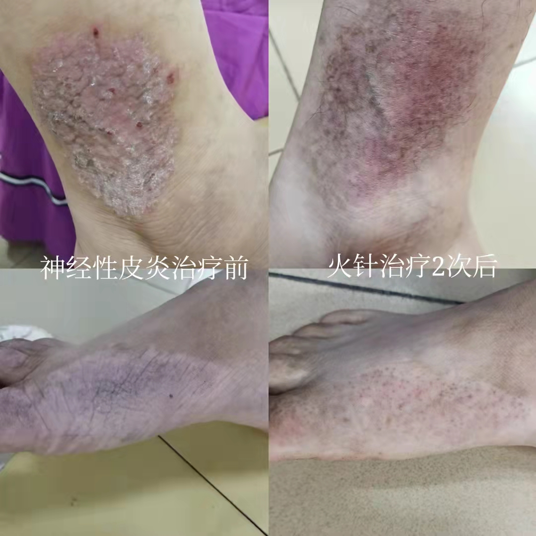Can Fire Needling Treat Skin Diseases?