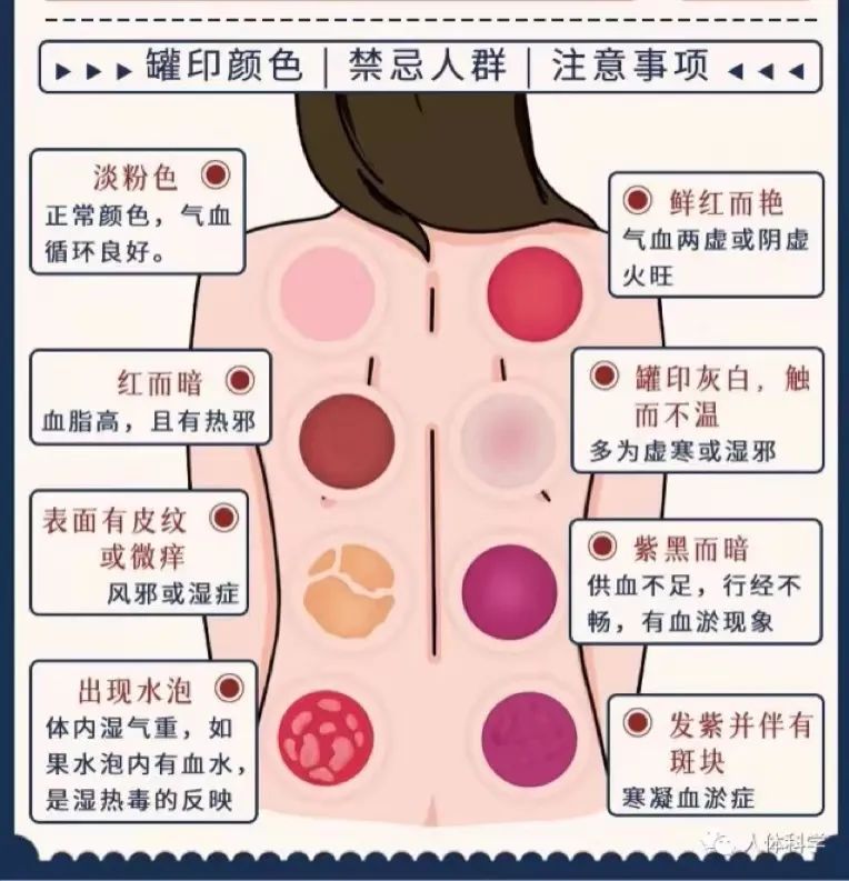 Essential Techniques for Treating Heat Stroke