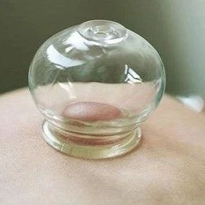 What is Cupping Therapy?