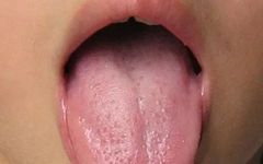 Five Types of Tongue Coating Symptoms and Corresponding Treatment Plans