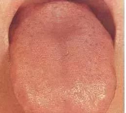 Understanding Tongue Diagnosis in Traditional Chinese Medicine (with Tongue Diagnosis Illustrations)