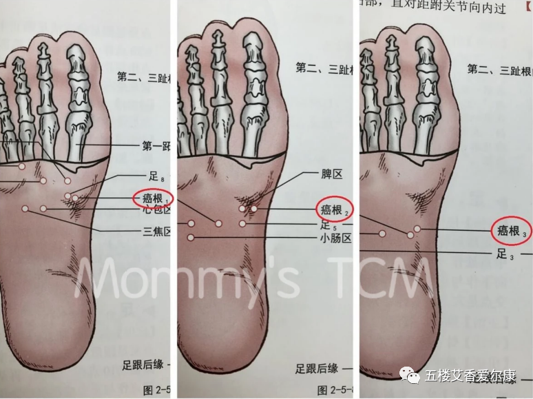 Summary of Common Diseases and Gua Sha Treatment Plans Including Human Reflex Maps, Contraindications, and Diagnosis of Sha Patterns