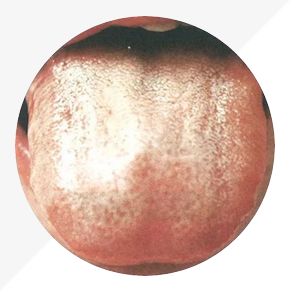 Understanding Tongue Diagnosis in TCM: Insights into Health from Tongue Appearance (Part 2)