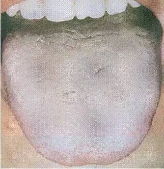 Tongue Diagnosis - Illustrated Guide to Tongue Manifestations