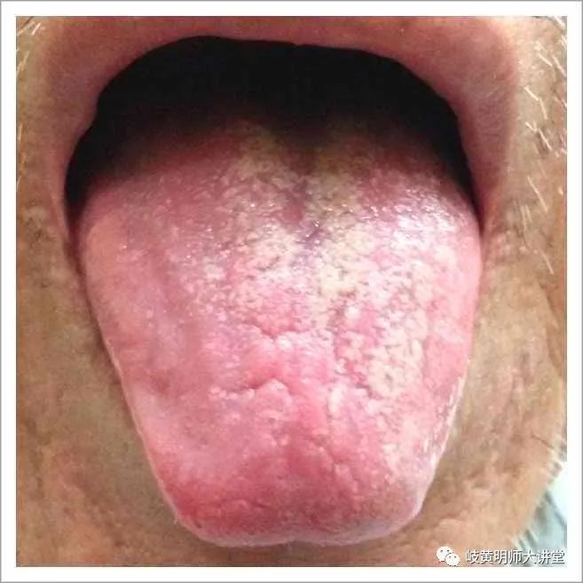 Traditional Chinese Medicine Tongue Diagnosis: Illustrated Guide to 14 Types of Tongue Shapes and Qualities