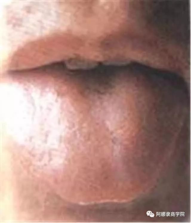 A Comprehensive Guide to 22 High-Definition Tongue Diagnosis Images: Understand Diseases Through Tongue Observation!
