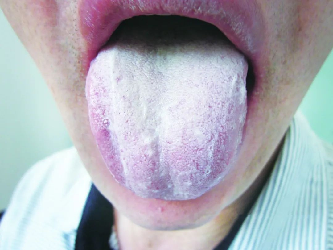 Is Phlegm-Dampness the Cause of Obesity and White Greasy Tongue? Dietary Therapy Solutions