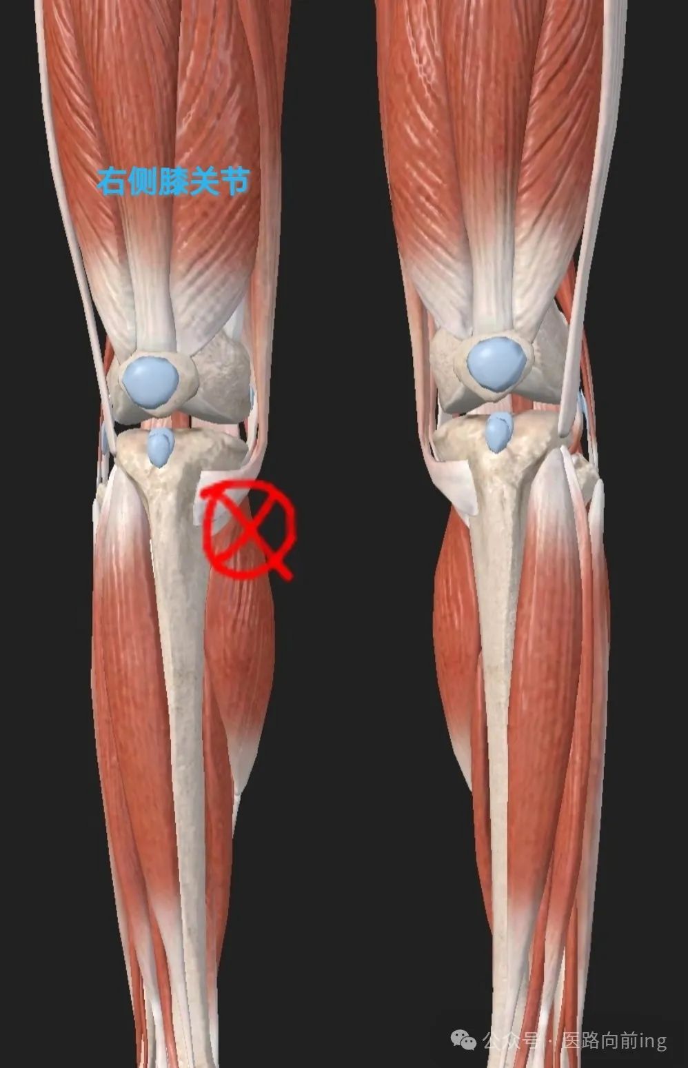 Relief from Medial Knee Pain: A Case Study of Acupuncture Treatment