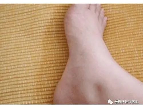 Understanding Qi Deficiency in Traditional Chinese Medicine