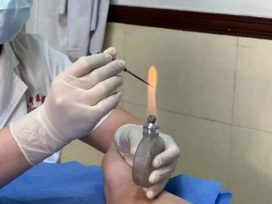 Understanding Fire Needle Therapy in Traditional Chinese Medicine