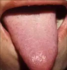 The Most Comprehensive Guide to Tongue Diagnosis! Master It and Become a Tongue Diagnosis Expert