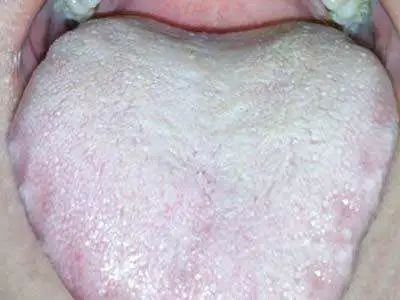 Four Tongue Coating Colors Revealing Your Body Condition