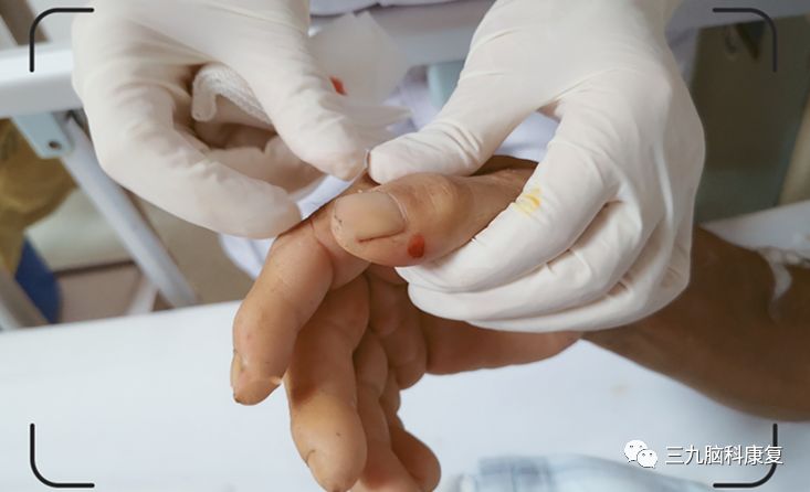 The Wonders of Bloodletting Therapy in Traditional Chinese Medicine