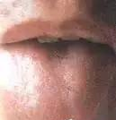 Comprehensive Guide to Tongue Diagnosis: Easily Understand Your Health Condition