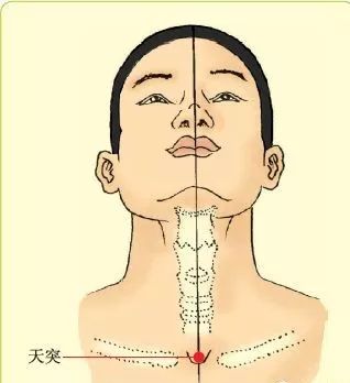 Cupping Therapy for Effective Treatment of Pharyngitis