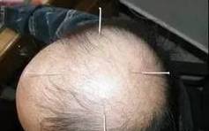 The Miraculous "Three Needles" in TCM Acupuncture: Treating One Disease with Three Acupuncture Points