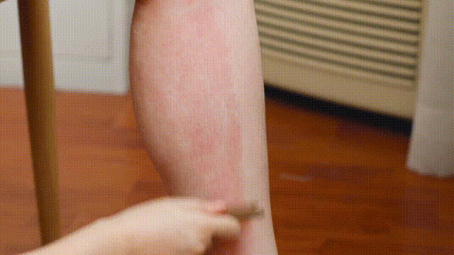 Highly Effective Gua Sha Technique to Remove Chronic Dampness and Toxins from the Body