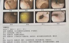 Zhang Litiao: Soothe the Liver and Relieve Depression, Harmonize the Stomach and Descend Rebellious Qi - A Case Study of Atrophic Gastritis