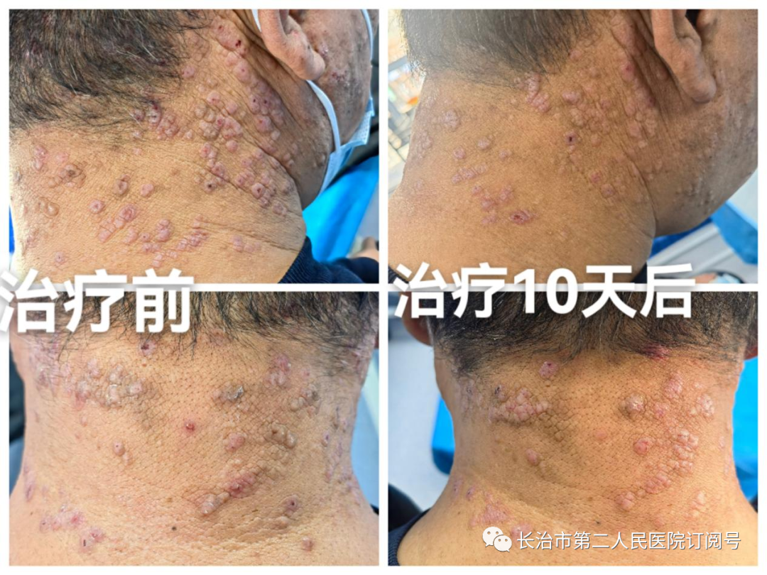 The Power of Fire Needling in Treating Skin Diseases