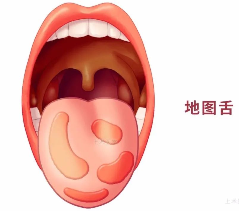 Observing Tongue Coating to Predict Diseases