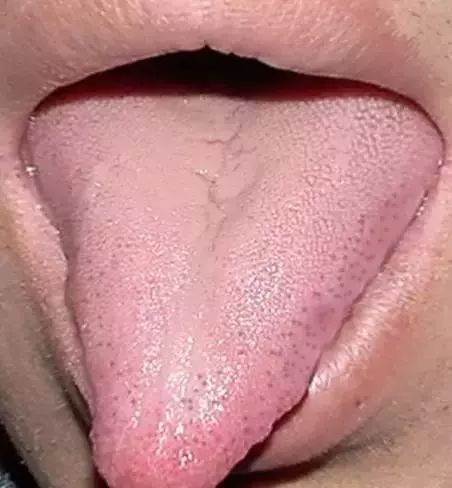 The Most Comprehensive Guide to Tongue Diagnosis! Master It and Become a Tongue Diagnosis Expert