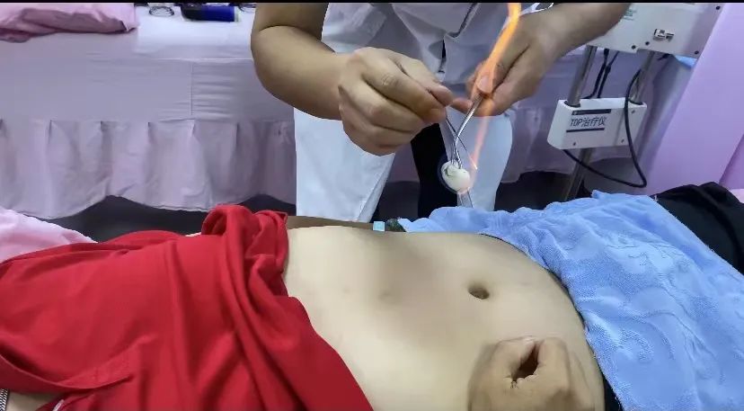 Fire Needle Therapy: A Unique Treatment in Traditional Chinese Medicine