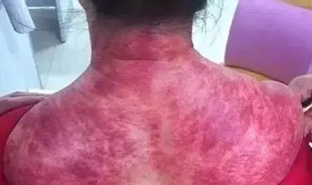 Benefits and Effects of Gua Sha on the Shoulders and Neck