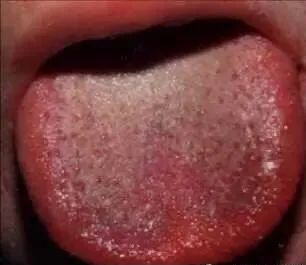 Tongue Diagnosis - Illustrated Guide to Tongue Manifestations