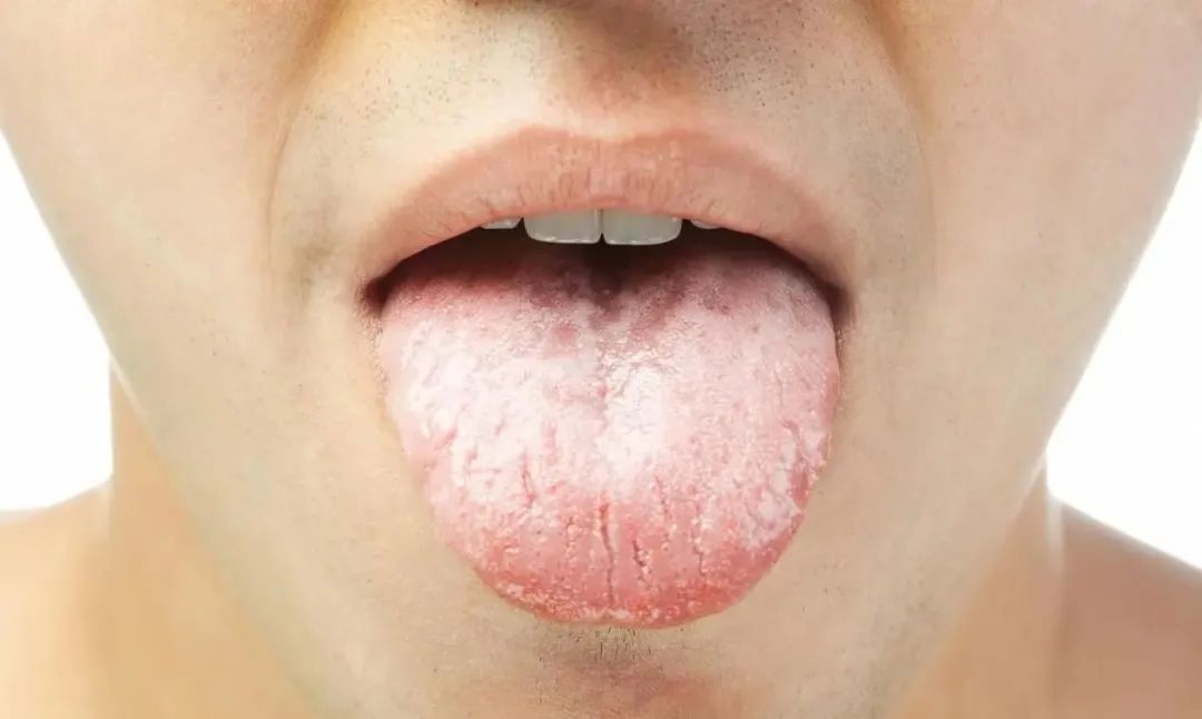 Traditional Chinese Medicine Tongue Diagnosis: What Different Tongue Appearances Indicate