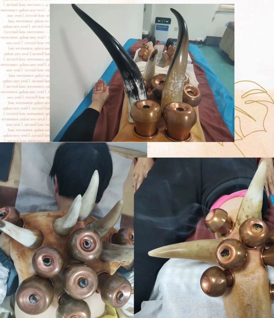 Orthopedic Specialty Therapy - Horn Cupping Therapy