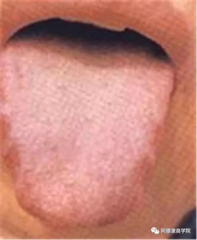 A Comprehensive Guide to 22 High-Definition Tongue Diagnosis Images: Understand Diseases Through Tongue Observation!