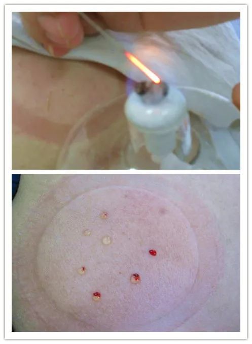 Characteristics of Fire Needle Therapy in Traditional Chinese Medicine