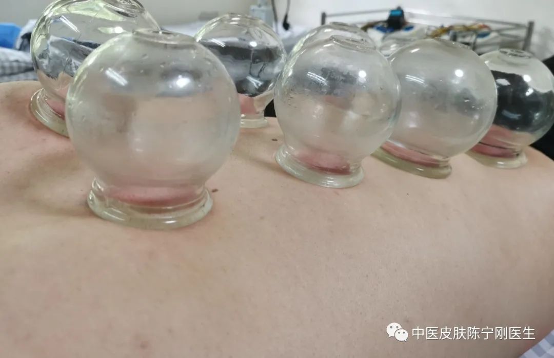 Cupping Therapy: A Traditional Method for Moisture Removal