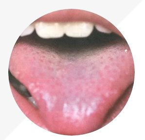Understanding Tongue Diagnosis in TCM: Insights into Health from Tongue Appearance (Part 2)