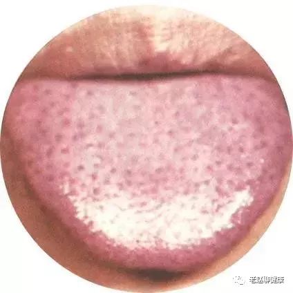 Learn Quick Ways to Observe Tongue Quality and Coating to Understand Your Health and Diseases!