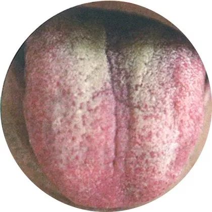 Comprehensive Guide to Tongue Diagnosis: A Must-Collect!