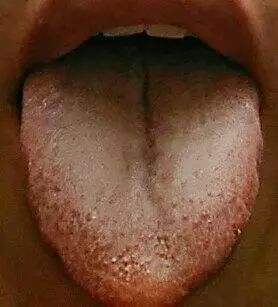 Precious Tongue Diagnosis: Identifying Stomach Yin Deficiency, Severe Yin Fluid Deficiency, Liver Blood Deficiency, and Yang Deficiency with Insufficient Qi and Blood