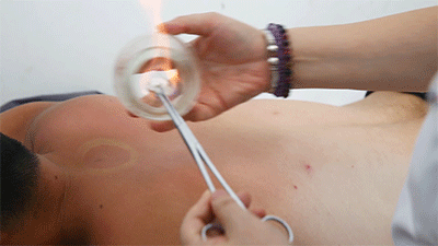 A Comprehensive Guide to Cupping Therapy