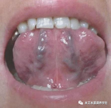 Tongue Diagnosis Series 3: Precise Differentiation of Tongue Coating, Quality, and Shape