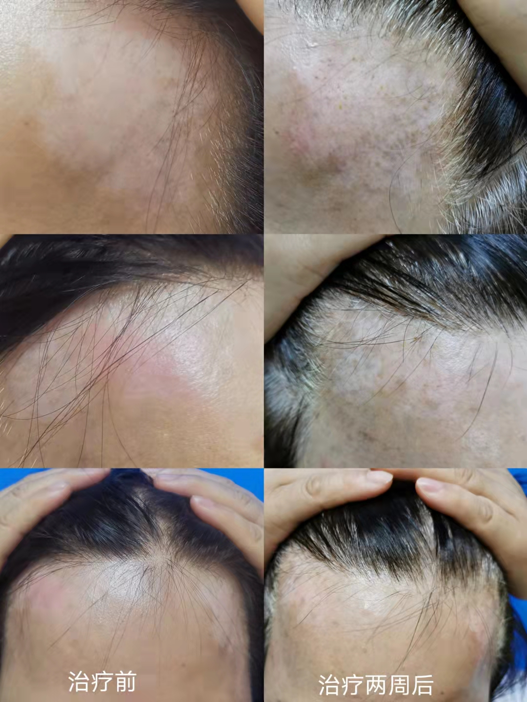 Can Fire Needling Treat Skin Diseases?