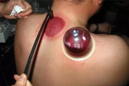 The Remarkable Practice of Bloodletting in Traditional Chinese Medicine