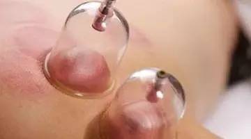 Methods of Cupping: Retention, Flash, and Sliding Techniques