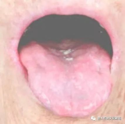 Tongue Diagnosis in Traditional Chinese Medicine: Characteristics of Tongue Coating
