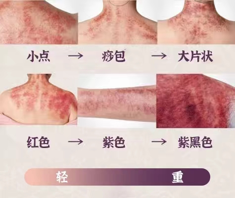 Understanding Gua Sha: What is the 'Sha' That is Scraped Out?