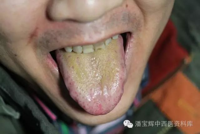 Foundations of Traditional Chinese Medicine: Phlegm-Dampness