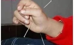 The Miraculous "Three Needles" in TCM Acupuncture: Treating One Disease with Three Acupuncture Points